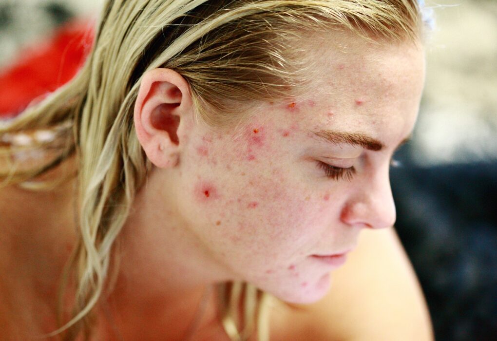 Acne-Scars