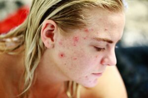 Acne-Scars